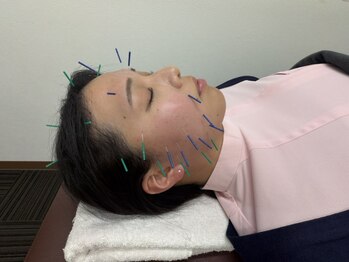 名倉堂鍼灸接骨院 天白区原駅前院/美容鍼