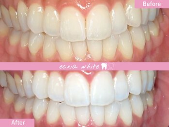 エクシアホワイトニング 札幌中島公園店/Before After［ホワイトニング］