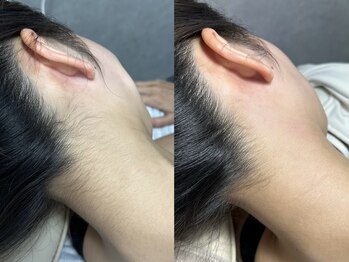 トゥウィーサロン 梅田(Tweesalon)/ツヤ肌フェイシャルワックス