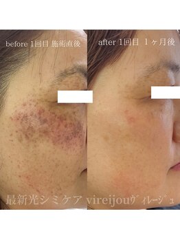 プライベートアイラッシュサロン ヴィレージュ 稲毛店(Vireijou)/大人気のシミケアで悩み解決！