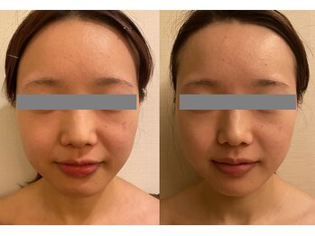 リンク 錦糸町店(Link)/BHF×6回（28歳）