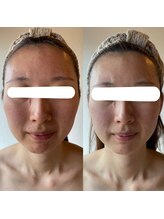 エステティックサロン ドゥネール/小顔2回目