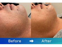 アリッサムフォーメン 岡山店(ALiSSUM for men)/アフター保証ご利用のお客様