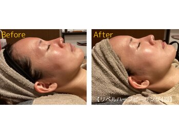 ロイヤリティ(ROYALTY)/毛穴/赤ら顔/肌のザラつき