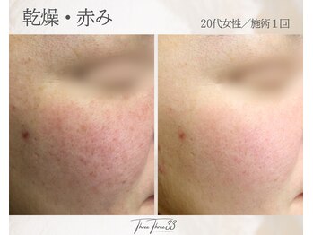 スリースリー(THREE THREE)/乾燥・赤みケア