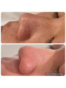 ラナン(ranan)/毛穴洗浄ピーリング