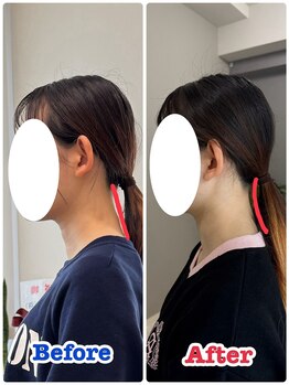 イデアル(iDeal)/スマホ首2ヶ月の変化