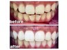 【ご新規様限定】歯のトーンアップ＊ホワイトニング　¥15,000→11,000