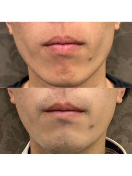 フェリーバ(FELIVA)/Before&After