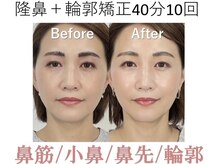 ラプリ 大阪心斎橋店(Raplit)/隆鼻＋輪郭矯正40分10回