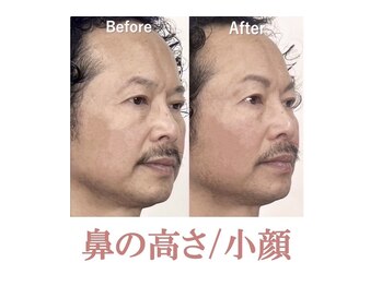 ラプリボーテ(Raplit BEAUTE)/隆鼻＋輪郭矯正40分20回