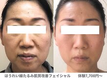 ピュアノア 垂水店/肌質改善フェイシャル　神戸垂水