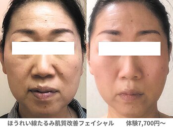 ピュアノア 垂水店/肌質改善フェイシャル　神戸垂水