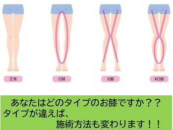 かえで鍼灸整体院/O脚やX脚でお悩みの方
