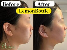レモンボトル導入で小顔に！【小顔./レモンボトル】