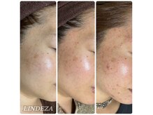 リンデザ(LINDEZA)の雰囲気（根本の毛穴・ニキビケアで、朝のメイクのストレスからも解放◎）