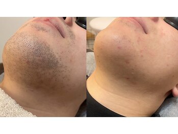 シエル(ciel.)/MEN'S 光脱毛★