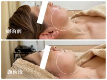 キーオブフェイス(Key of Face)/お悩み【口横のたるみ下がり】