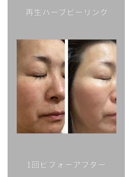 リクラ 北千住(Reclat)/1回再生ハーブピーリング