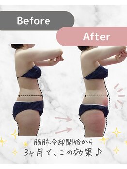 ミネット(minette)/脂肪冷却*before→after
