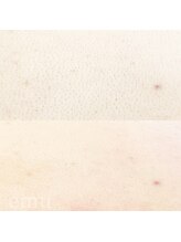 エミュ(emu)/背中wax＆光脱毛