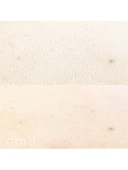 エミュ(emu)/背中wax＆光脱毛