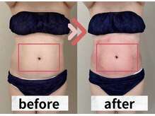 イヨヨ(iyoyo)/【痩身】Before After