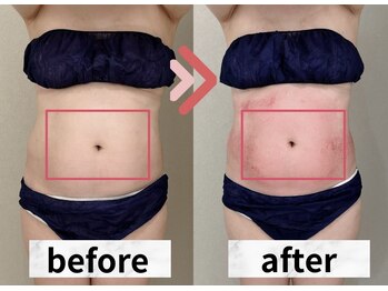 イヨヨ(iyoyo)/【痩身】Before After