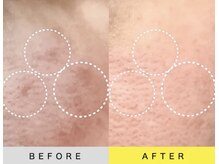 ソアン(Soin)/ダクトピール