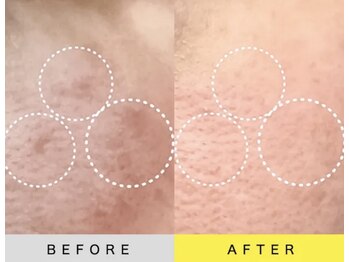 ソアン(Soin)/ダクトピール