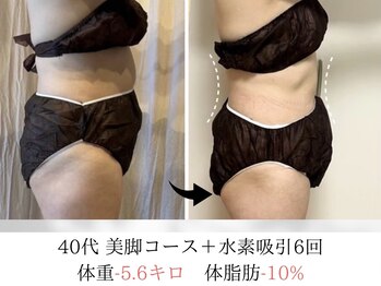 ヨサパーク タキ 上野毛(YOSA PARK TAKI)/40代・美脚コース＋水素吸引6回