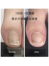 巻き爪改善