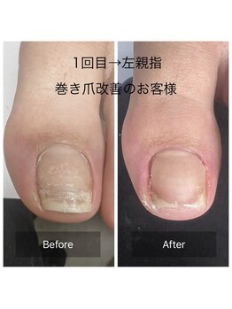 ヴィヴィアンヌ(VIVIANNE)/巻き爪改善