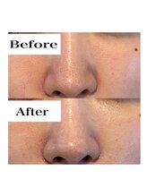 ライム 池袋東口(LIME)/Before&After　鼻