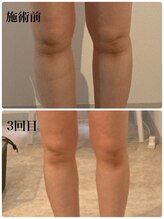 ティティー(tity)/下半身痩身モニター様