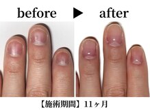 リング ザ ベル(ring the bell)/メンズプレミアムコース¥19.800