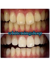 ホワイトニングショップ 吉祥寺店/BEFORE ＆ AFTER