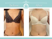 美人バスト 浜松店/◇ バストアップ &nbsp;BeforeAfter◇