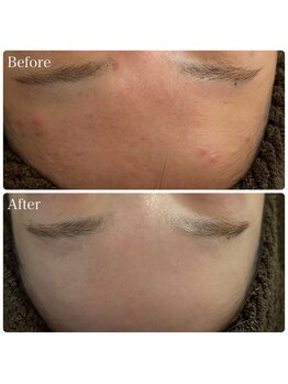 ブリエ(Briller)/おでこのニキビ