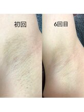ティンクルホワイト 上尾店/脇脱毛施術