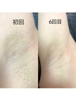 ティンクルホワイト 上尾店/脇脱毛施術