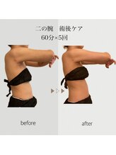 ファミーユ 名古屋店/【術後ケア】二の腕吸引後ケア