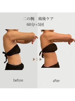 ファミーユ 名古屋店/【術後ケア】二の腕吸引後ケア