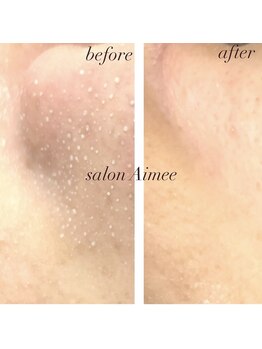 エイミー(Aimee)/【毛穴コース】ビフォーアフター