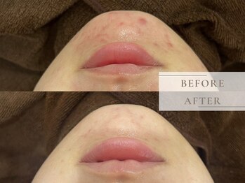 レヴィア(Revia)/REVIハーブピーリング4回の変化