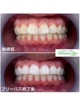 ホワイトニングサロン 名古屋駅店/【ホワイトニング施術例】
