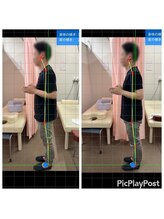 北船岡整骨院 イオン船岡店/ABC矯正１回目before/after写真