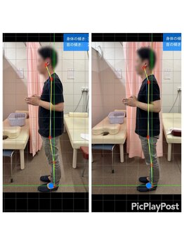 北船岡整骨院 イオン船岡店/ABC矯正1回目before/after写真