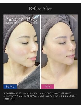 サロン ダリア(Salon Dahlia)/リフトアップコース