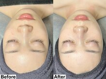 低刺激で角質を整え、透明感とツヤを引き出すララピールが大人気